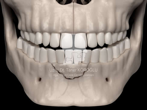 Alveolar kırık - Bursa Diş Hekimi