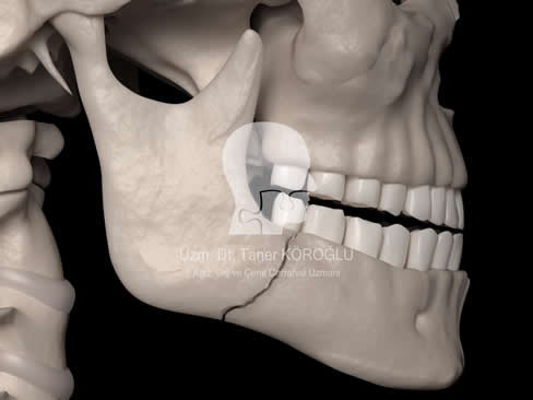 Ramus Kırığı - Bursa Diş Hekimi