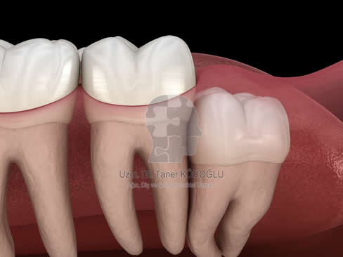 Gömülü Diş Tedavisi - Bursa Diş Hekimi