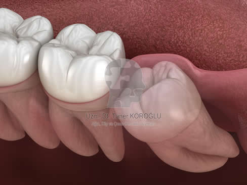 Gömülü Diş Tedavisi - Bursa Diş Hekimi