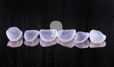 Porselen Lamina Tedavisi - Bursa Diş Hekimi