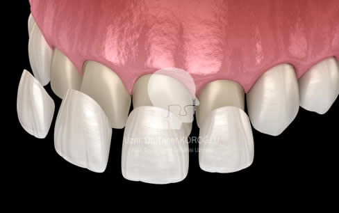 Porselen Lamina Tedavisi - Bursa Diş Hekimi