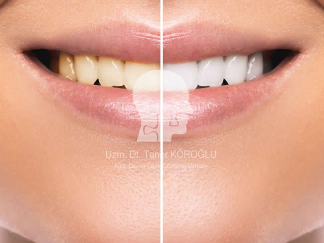 Diş Beyazlatma - Bursa Diş Kliniği