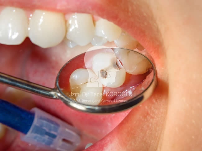 Diş Çürüğü Tedavisi - Bursa Diş Hekimi