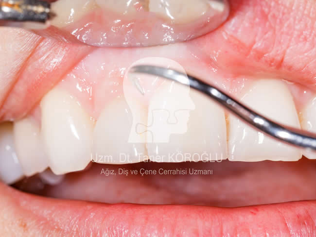 Diş Eti Tedavisi - Bursa Diş Hekimi