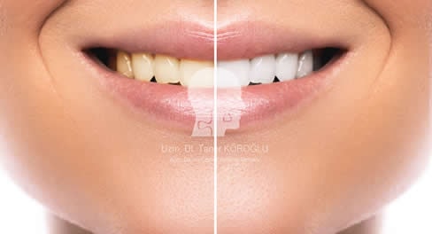 Diş Beyazlatma - Bursa Diş Hekimi