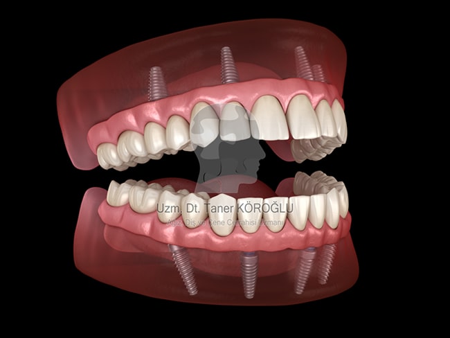 Genel Anestezi İle Diş Tedavisi - Bursa