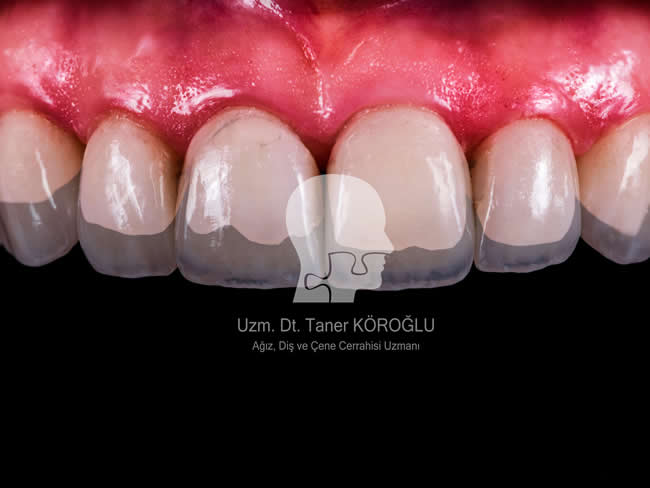 Gülüş Tasarımı - Bursa Diş Kliniği