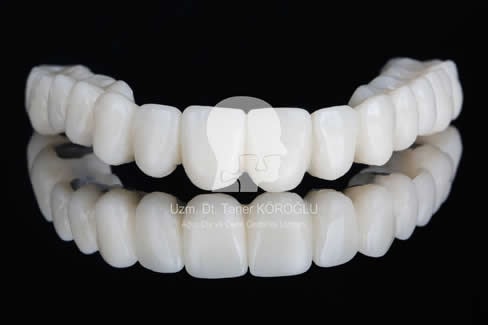 Porselen Diş Kaplama - Bursa Diş Hekimi