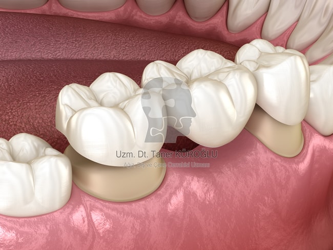 Diş Protezi Öncesi Cerrahi Uygulamalar - Bursa